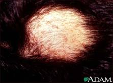 Hypnosis May Improve Type of Hair Loss